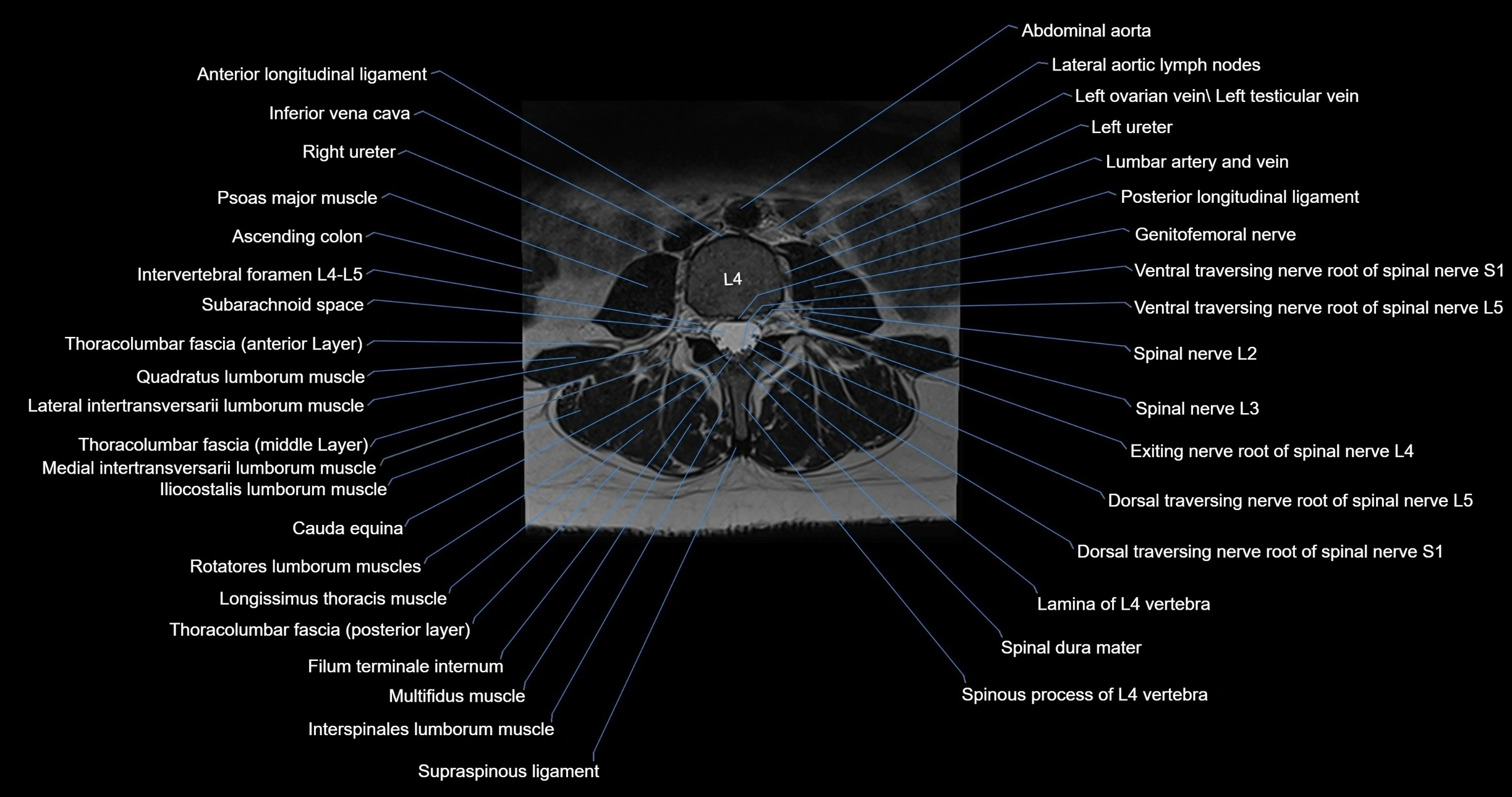 MRI lumbar spine axial cross sectional anatomy 3T radiology  image-img-00001-00031.webp